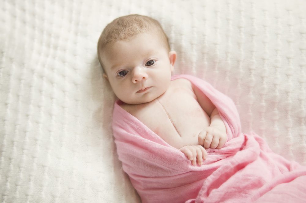 congenital heart disease